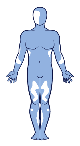 Mixed vitiligo